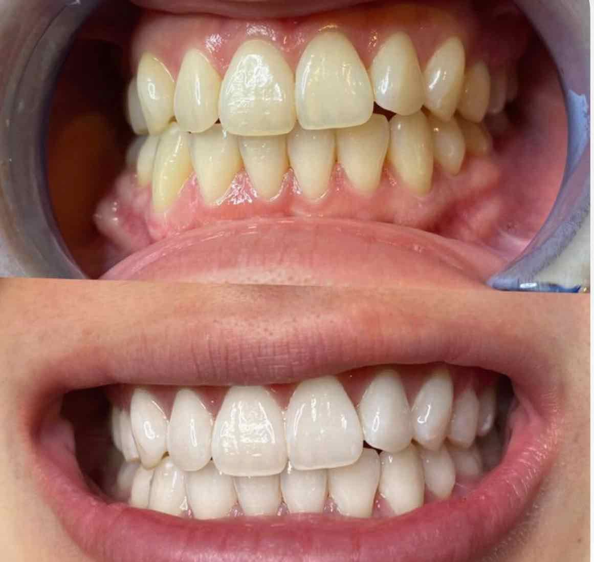 Blanchiment dentaire 