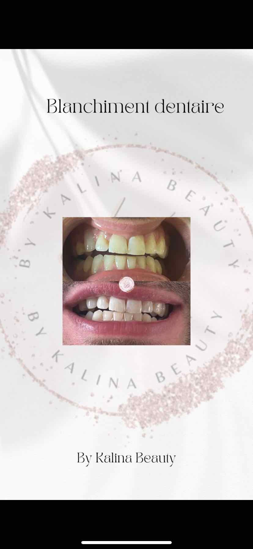 blanchiment dentaire
